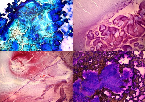 Photos featured in ‘Art in the Shadows,’ a new exhibit set to be on display at the Urban Arts Space beginning Sept. 6 through Oct. 4. The images — shot by Amy Joehline-Price, a resident pathologist at the Wexner Medical Center — zoom in on lab samples only seen clearly through a microscope, including biopsies and surgical tissue. The exhibit is to be the first for the gallery, which is owned by OSU and located in downtown Columbus, to mix art with medicine.  Credit: Courtesy of Amy Joehline-Price