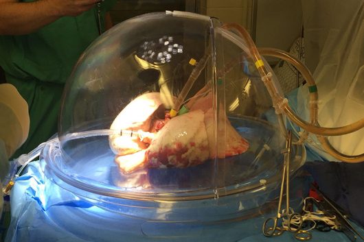 A lung undergoes ex-vivo lung perfusion at the Wexner Medical Center. Credit: Courtesy of Ohio State